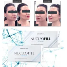 Buy Nucleofill or Profhilo Strong Medium 1.5ml Soft Eyes Hair Mesotherapy Lifting at Cellular Level Treatment Skin Boosters Firming Anti Aging Wrinkles Products